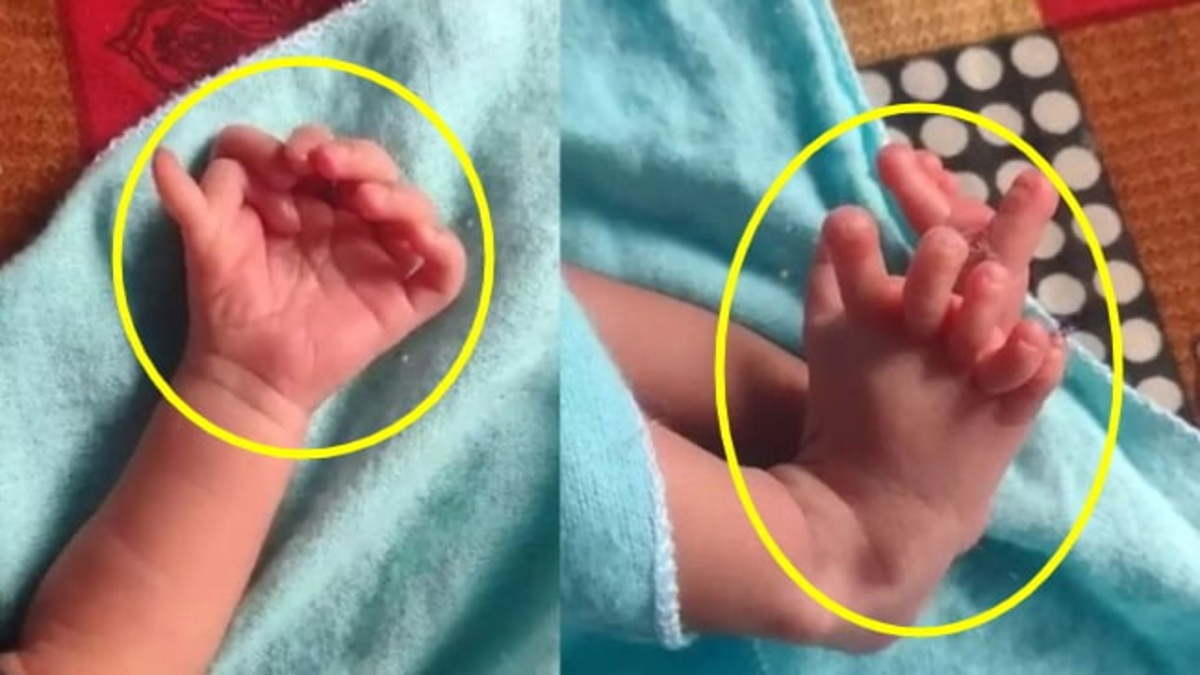 Baby with 14 Fingers and 12 Toes Born in India Sparks Fascination