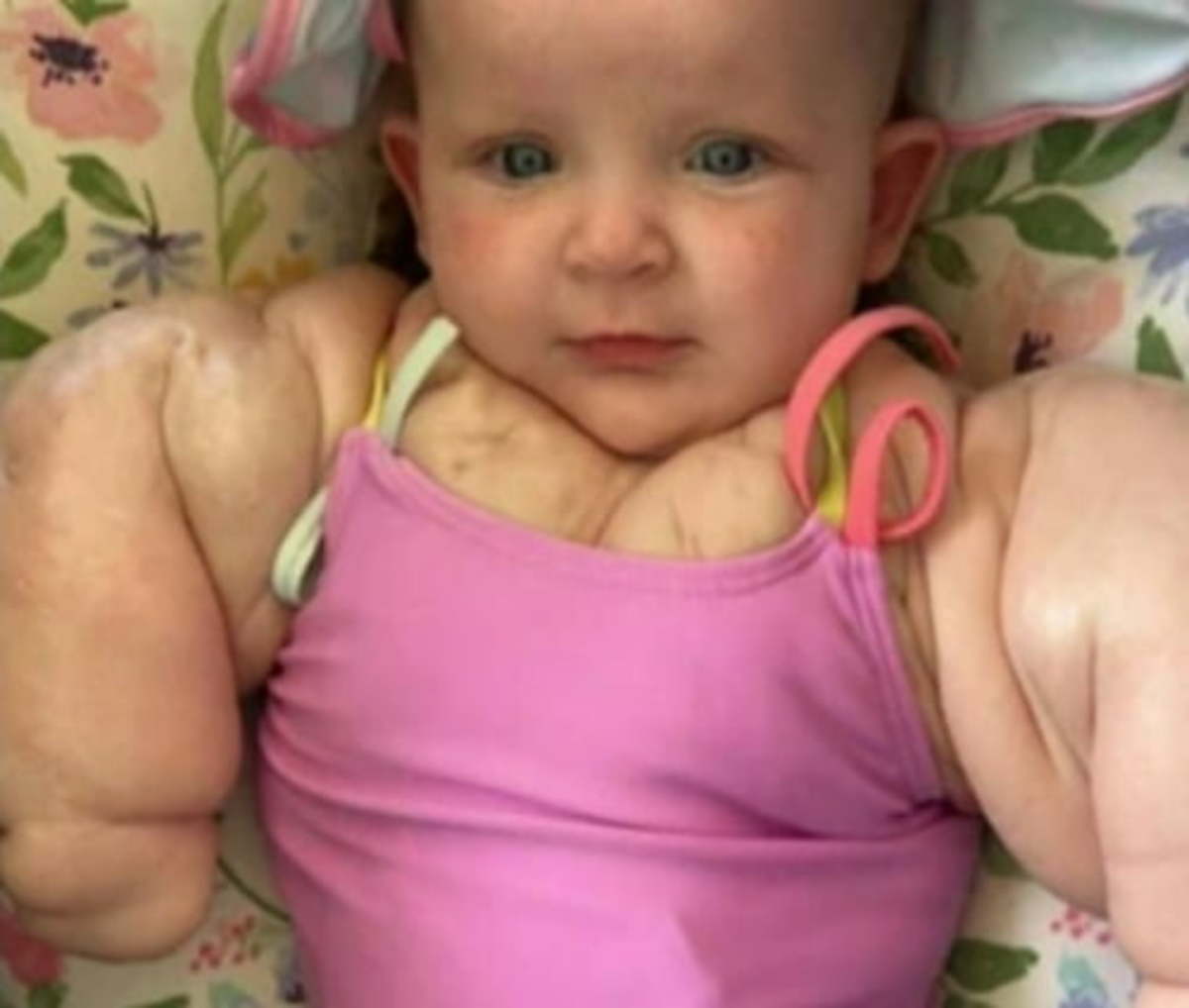 baby-hulk-the-inspiring-story-of-a-9-month-old-with-lymphangioma