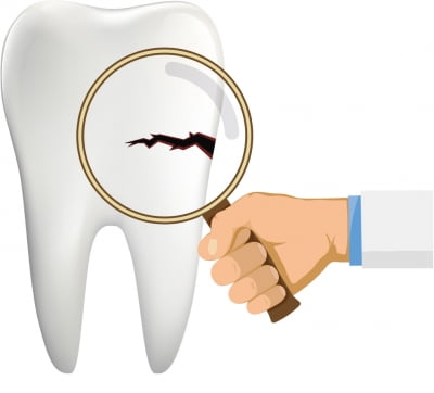 치아에 금이 갔습니다…어떻게 하죠? [건강]