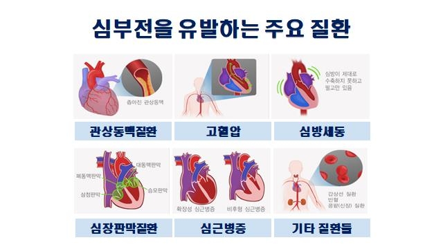 [위클리 건강] "스텐트 시술에도 심해진 호흡곤란…알고보니 원인은 '심부전'"