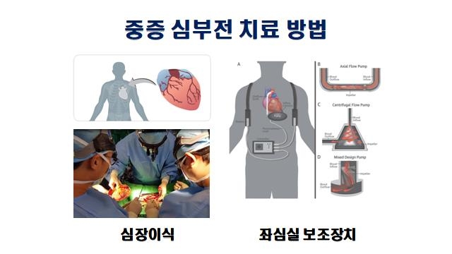 [위클리 건강] "스텐트 시술에도 심해진 호흡곤란…알고보니 원인은 '심부전'"