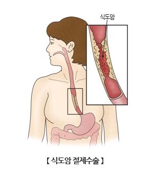 "식도암 유발 변이유전자 발견"