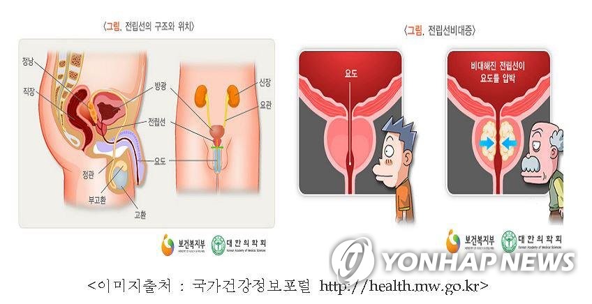 "홍삼 뿌리 오일, 전립선 비대증에 효과…성기능 개선 확인"