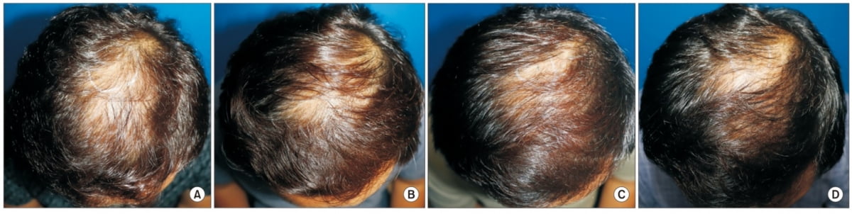 C3샴푸(MARE 함유)의 임상결과 탈모 환자에서 발모 효과를 확인할 수 있었다. 출처= 강북삼성병원 김진섭 김원석 교수팀 논문(대한의학레이저학회 게재)