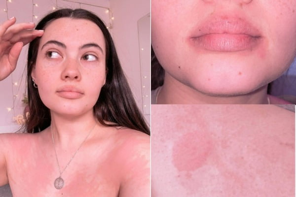 '수성 알레르기'를 앓고 있는 20대 미국 여성의 모습. /사진=인스타그램 계정 '리빙워터리스(livingwaterless)' 캡처