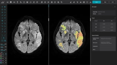제이엘케이, 뇌졸중 AI 유형분류 솔루션 수가 5만4300원