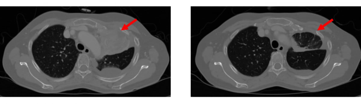 에이비온의 폐암 신약후보물질 바바매킵 임상2상 투약환자의 CT스캔 결과. 투약 3주 후 암세포 32%가 사라진 장면. 에이비온 제공