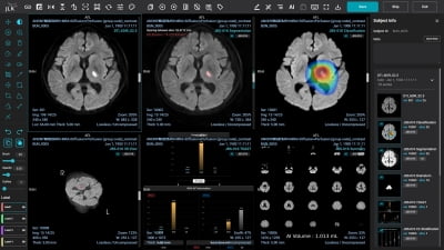 제이엘케이, 필리핀 군병원에 ‘AI 뇌졸중 솔루션’ 도입 완료