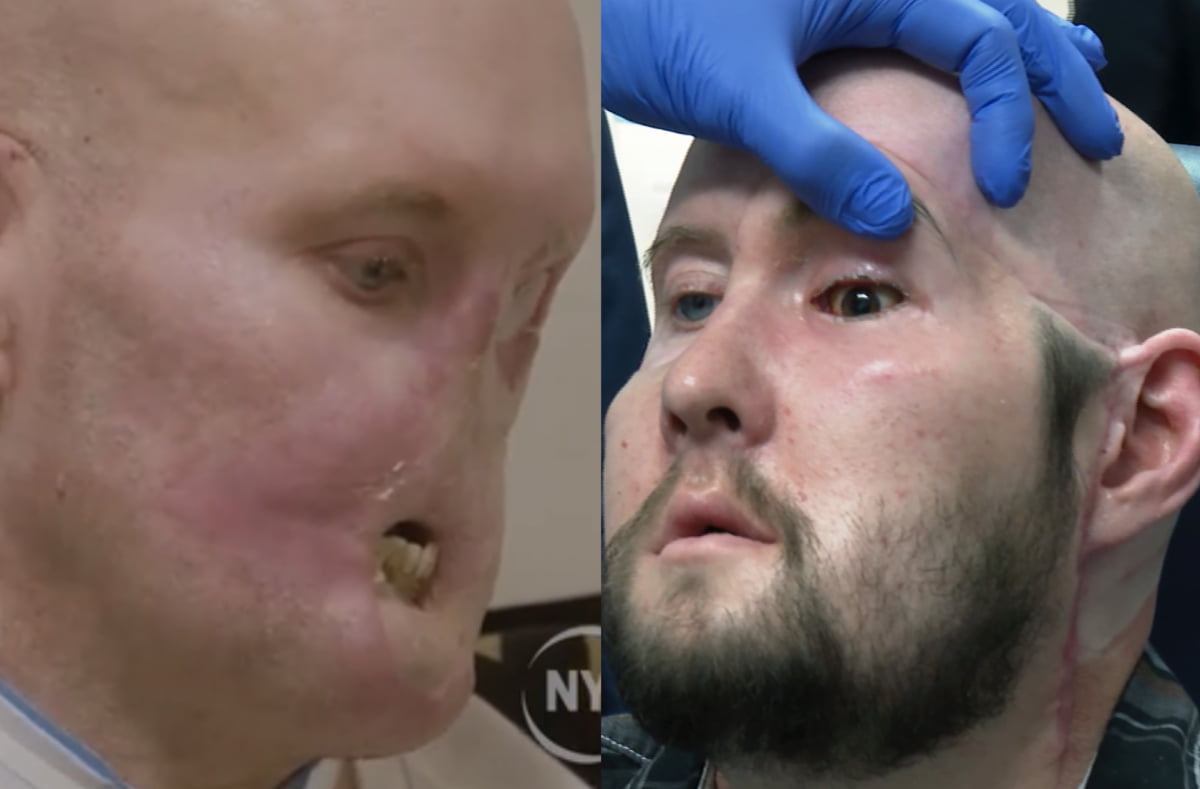 세계 최초로 안구 이식 수술을 받은 미국인 애런 제임스. 왼쪽은 수술 전 사진. /사진=미국 뉴욕대 랑곤헬스, 연합AP