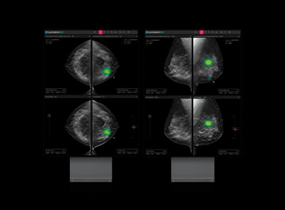 루닛, 3D 유방암 검진 '루닛 인사이트 DBT' 美 FDA 승인 획득