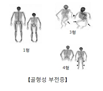 뼈 쉽게 부러지는 '골형성부전증' 치료 연구 심의 통과