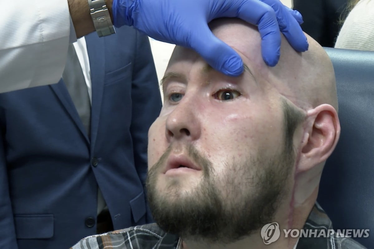 세계 최초로 안구 이식…시력회복 여부 '촉각'