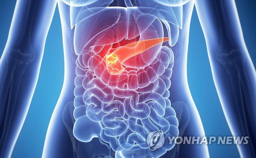 "당뇨환자 흡연하면 췌장암 발병 위험 2.7배 증가"