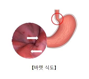 "염증성 장 질환, 바렛 식도와도 연관"