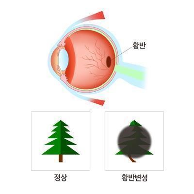 "퇴행성 안구 질환 잡아라"…제약업계, 황반변성약 개발 경쟁