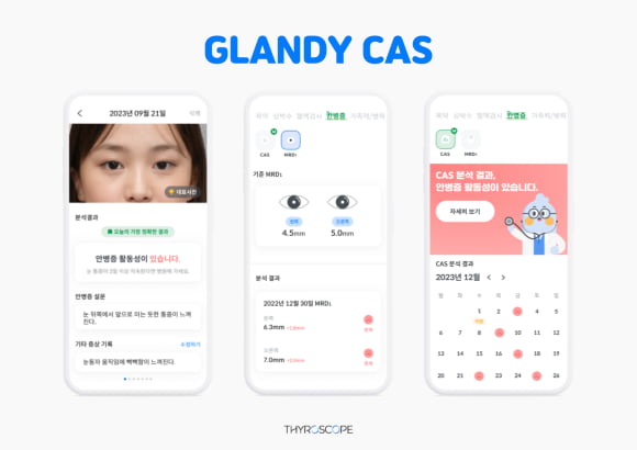 타이로스코프, 갑상선 안병증 디지털 모니터링 솔루션 상용화 첫발