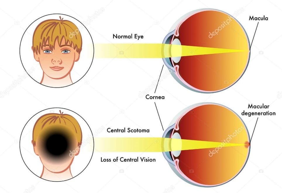[도판 8] 정상 시각 황반변성으로 인해 중앙시를 잃었을 때의 시각 비교
