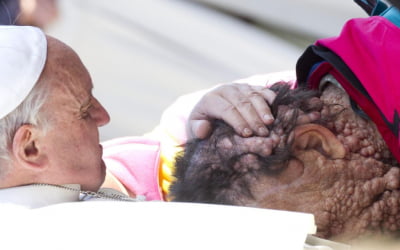 교황 '축복의 키스' 받았던 신경섬유종 환자, 세상 떠났다