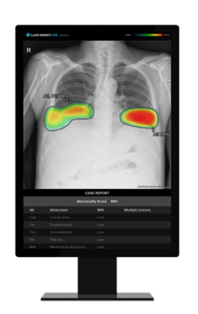 루닛의 흉부 엑스레이 AI 영상분석 솔루션 ‘루닛 인사이트 CXR’/사진 제공=루닛