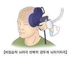 "MRI 유도 뇌 자기자극으로 난치성 우울증 치료"