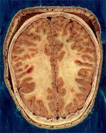 "치매 진단 5~10년 전 뇌 회색질 두께 얇아져"