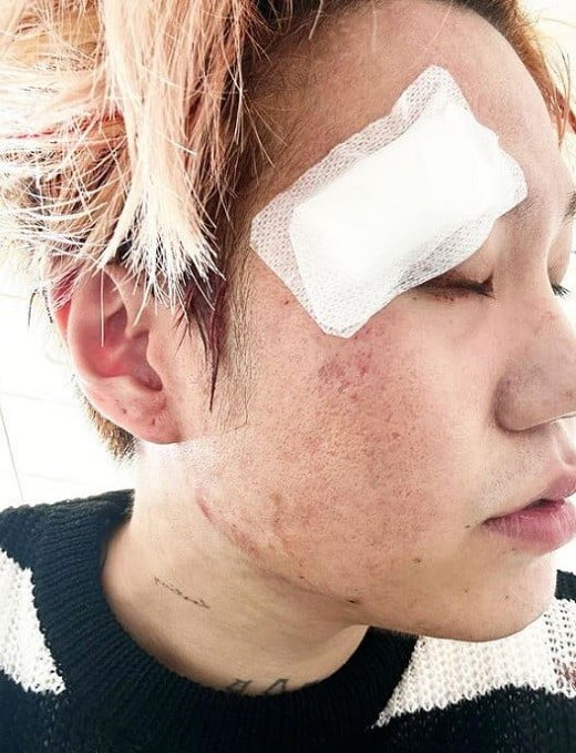 「大発作で気絶」ブルー、突然のコンサート不参加理由