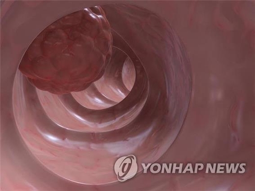 "대장암 진단 새 분변 검사법 개발"
