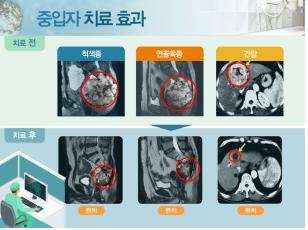 꿈의 암 치료기 기장 중입자 가속기 구조 변경…2027년 가동