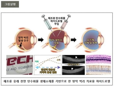 실명 유발 '망막 박리' 해조류로 치료…인공 유리체 소재 개발