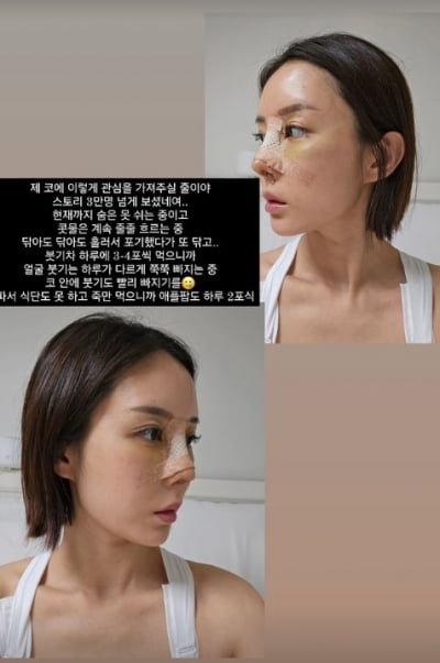 "가슴 수술보다 더 아파"…'돌싱글즈' 이소라, 코 성형 생생 후기