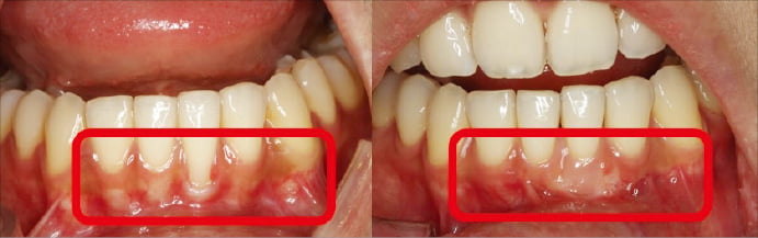 잇몸이식술을 통해 노출된 치근면을 덮기 전(왼쪽)과 치료 후 모습(오른쪽). 