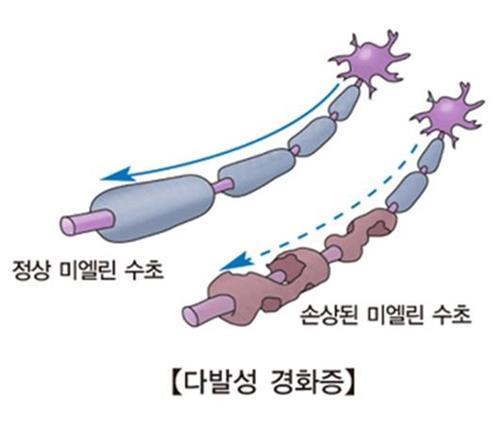 "다발성 경화증 환자 비만하면 진행 빠르다"