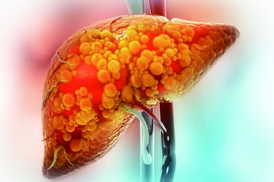 [이슈 분석] MASH 치료제 ‘레즈디프라’ 세계 첫 승인, 차세대 치료제의 패러다임 제시