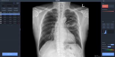 뷰노, UAE 군병원에 흉부 엑스레이 AI 솔루션 도입…"하반기 FDA 허가 목표"