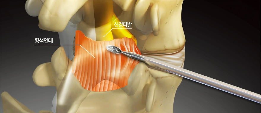 < 추간공확장술 기계적 치료 원리 > 척추관 후방부의 황색인대를 특수 키트로 절제해 물리적 공간을 확보하는 모습. 