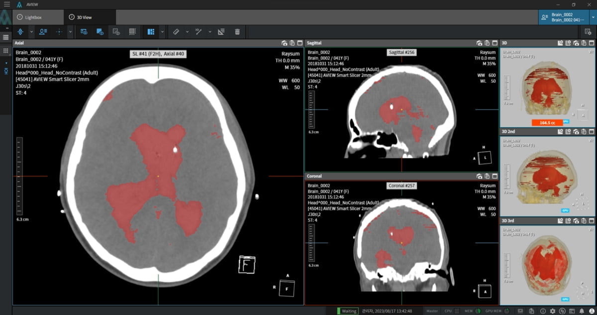 코어라인소프트, 뇌출혈 AI 의료 솔루션 병원 비급여 청구 시작