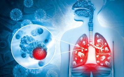 KIST, 비흡연 폐암 표적치료 길 열었다