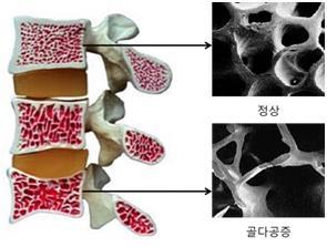 [김길원의 헬스노트] "뼈 갉아먹는 흡연…금연하면 골절 위험 '뚝'"