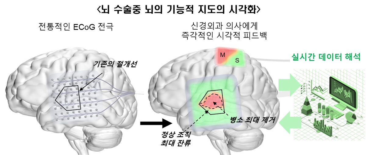 UNIST "뇌 활동 실시간 시각화 기술 개발…수술 성공률 개선"