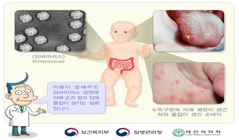 백신 없는 수족구병, 최근 한 달간 2.3배↑…영유아가 90%