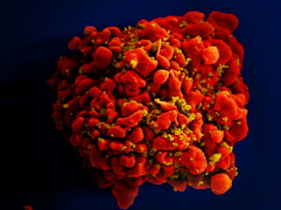 에이즈 완치 시대 열리나…조혈모세포 이식으로 HIV 사멸