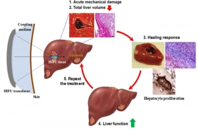 간이식만이 답이었던 '간경화'···초음파 치료법 국내 의료진 최초 개발