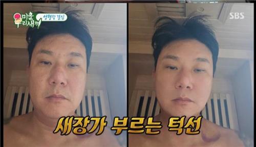 '쿨해진' 성형 고백…방송 중 수술 붕대 감고 나오는 요즘 예능