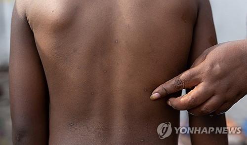 부룬디서 엠폭스 첫 감염 환자…"확진자 3명 치료중"