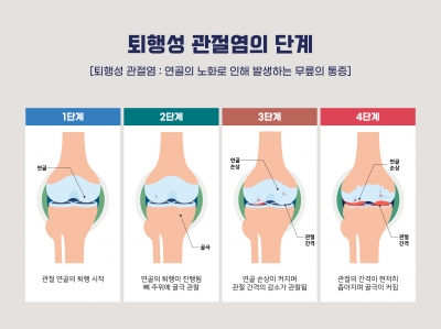 [분석+] 넥스트바이오메디컬·오브이메디…15조 관절염 시장 정조준