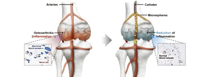 넥스트바이오메디컬의 ‘넥스피어 에프’의 작용 기전을 설명한 그림. 관절염을 유발하는 혈관에 넥스피어 에프를 주사한 이후, 염증을 유발하는 신경 세포 등이 사라진 모습이다. /넥스트바이오메디컬 홈페이지 