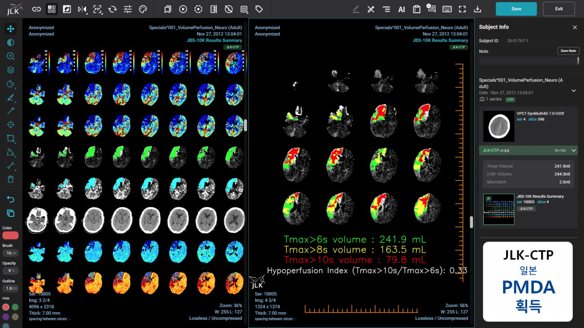 제이엘케이의 뇌 관류영상 분석 솔루션 JLK-CTP. 제이엘케이 제공