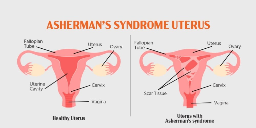 정상 자궁과 애셔맨 증후군 가진 자궁의 차이 / 이미지출처. bankerivf.com