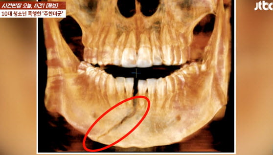 주한미군에 맞아 턱뼈가 골절된 10대 남학생의 엑스레이 사진 / 사진=JTBC 사건반장 방송 캡처