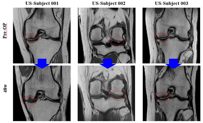 바이오솔루션이 10일(현지 시간) 미국 샌디에이고에서 열린 ‘미국 정형외과 학회(AAOS 2025)’에 참석해 미국 임상 2상 중간결과를 발표했다. 수술 전 환자(위)의 무릎 연골이 수술 후(아래) 개선됐음을 확인할 수 있다. 바이오솔루션 제공
